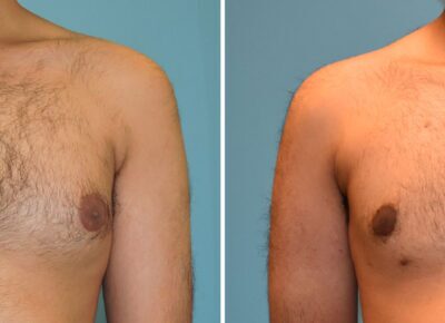 Gynecomastia – Dr. Zeiderman Patient 1
