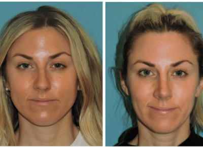 Rhinoplasty – Dr. Snyder Patient 10