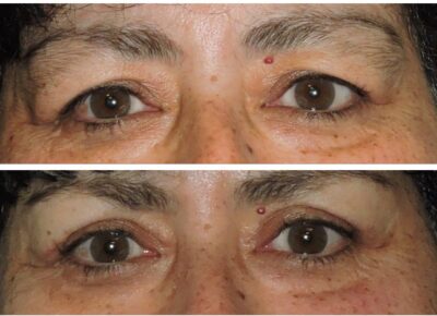 Blepharoplasty – Dr. Snyder Patient 16