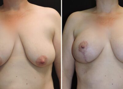 Breast Lift with Implants – Dr. Zeiderman