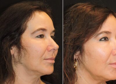 Blepharoplasty – Dr. Zeiderman