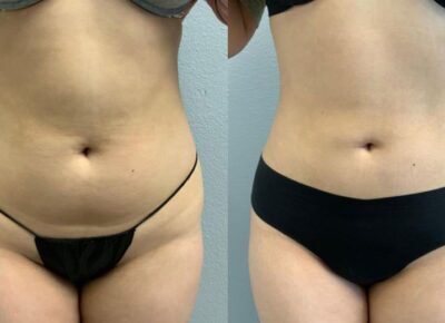 Liposuction Patient 1