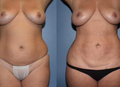 Liposuction Patient 3
