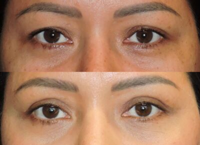 Blepharoplasty Dr. Zeiderman Patient 3
