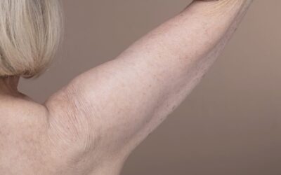 Arm Lift Surgery: Is Brachioplasty Right For You?