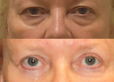 Blepharoplasty Dr. Zeiderman Patient 4