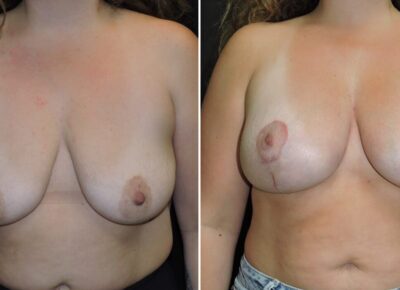 Breast Lift with Implants – Dr Zeiderman