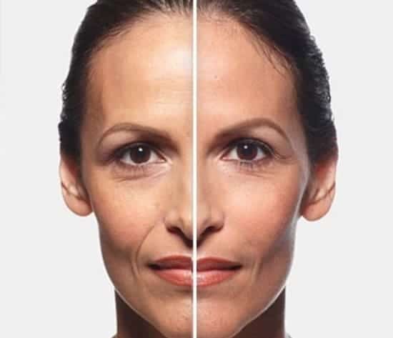 Before and after Juvéderm XC fillers showing smoother skin and reduced wrinkles on middle-aged woman.