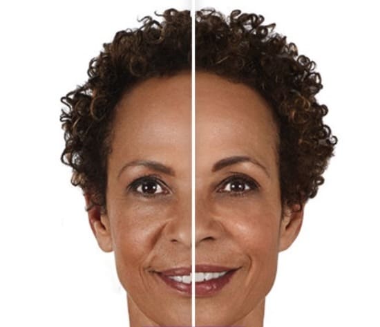 Before and after Juvéderm XC fillers showing fuller cheeks and softened lines on smiling woman.