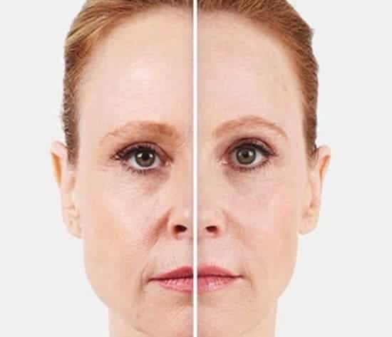 fillers-4