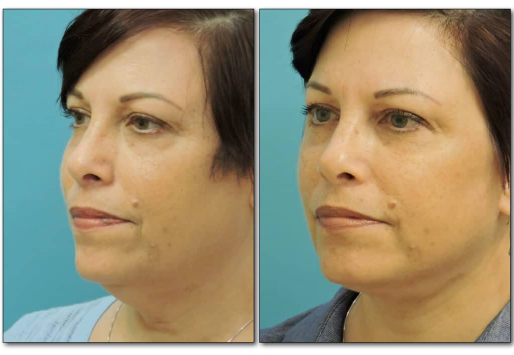 litelift-plastic-surgery-2