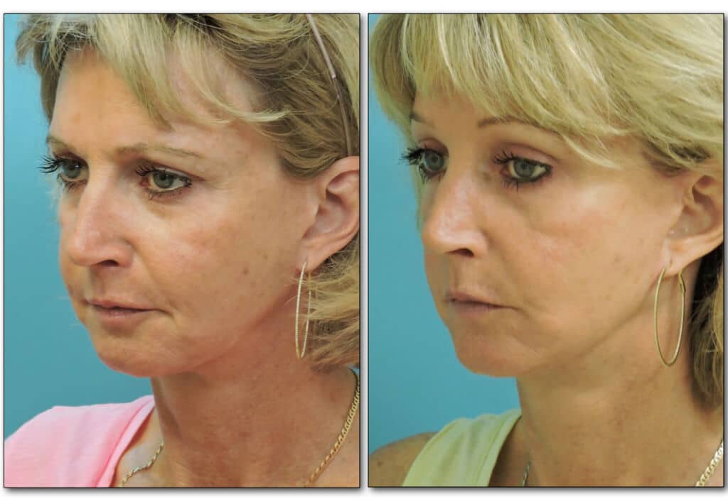 litelift-plastic-surgery-3