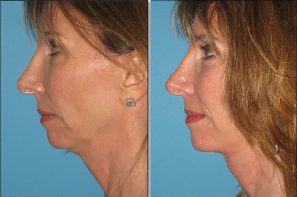 Before and after LiteLift facial rejuvenation showing tighter jawline and smoother neck profile in woman.