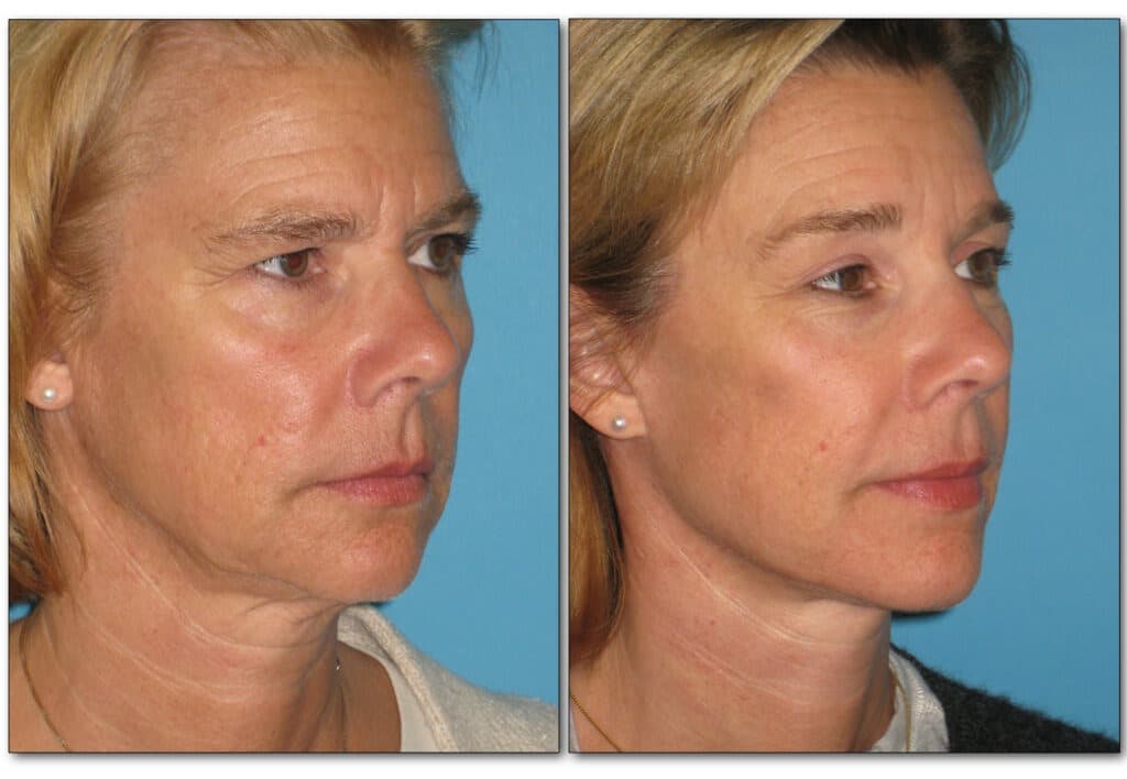 Before and after brow lift showing lifted brows and smoother forehead lines in female patient.