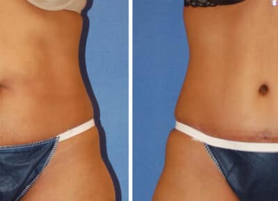 Abdominoplasty Patient – 7