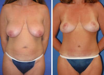 Abdominoplasty Patient – 9