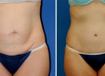 Abdominoplasty Patient – 3
