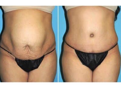 Abdominoplasty Dr Snyder 1