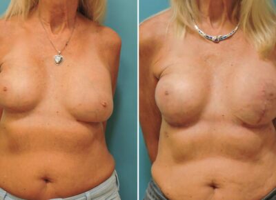 Breast Reconstruction Patient 1