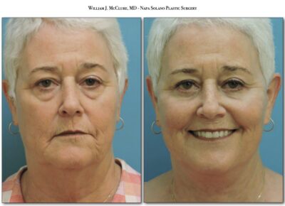 Facelift – Dr. McClure 19