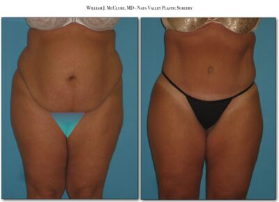 Abdominoplasty – Dr. McClure 2