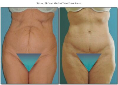 Abdominoplasty – Dr. McClure 7