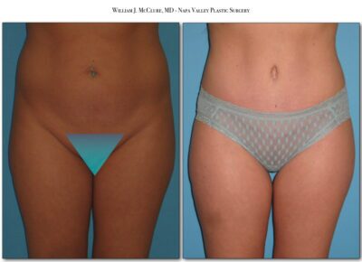 Abdominoplasty – Dr. McClure 10