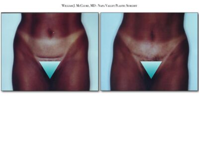 Abdominoplasty – Dr. McClure 14
