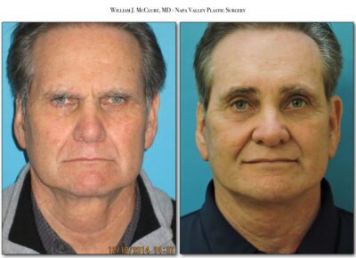 Facelift – Dr. McClure 44