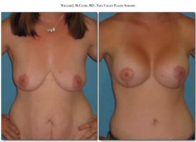 Mommy Makeover – Dr. McClure 7