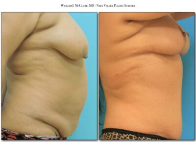 Mommy Makeover – Dr. McClure 1