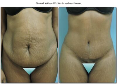 Abdominoplasty – Dr. McClure 1