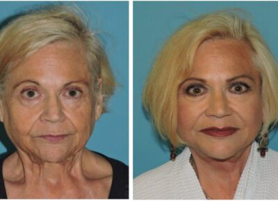 Facelift – Dr. Snyder Patient 11