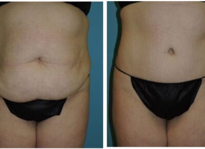 Abdominoplasty – Dr. Snyder Patient 13
