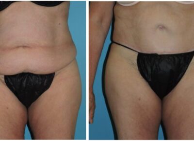 Abdominoplasty – Dr. Snyder Patient 12