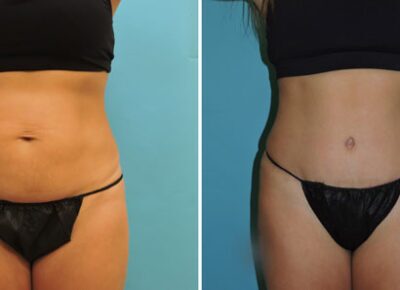 Abdominoplasty – Dr. Zeiderman Patient 3