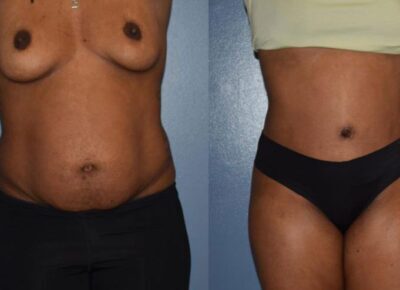 Abdominoplasty Patient 1