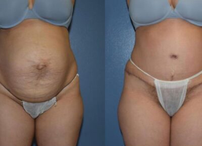 Abdominoplasty Patient 2