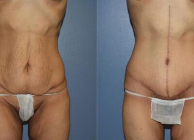 Abdominoplasty Patient 3