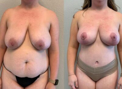 Mommy Makeover Patient 2