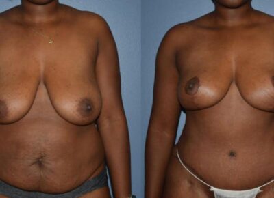 Mommy Makeover Patient 3