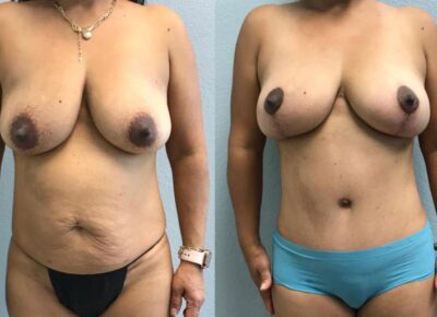 Mommy Makeover Patient 4