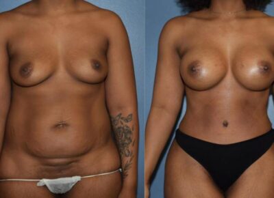Mommy Makeover Patient 5