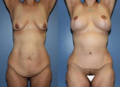 Mommy Makeover Patient 7