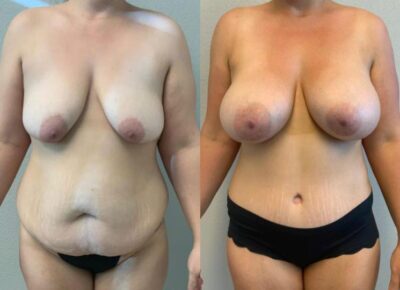 Mommy Makeover Patient 8