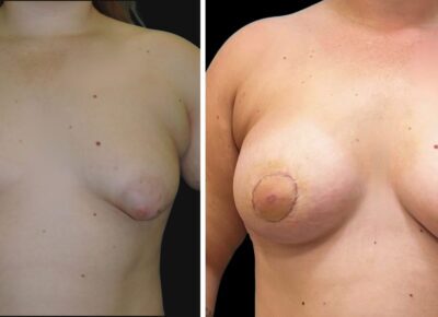 Breast Reconstruction Patient 2