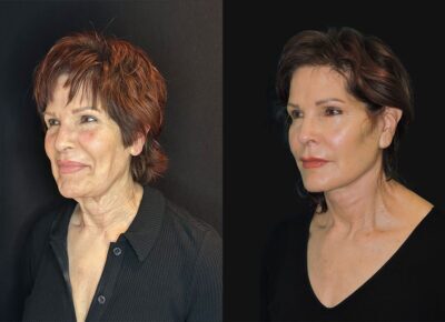 Facelift and Necklift – Zeiderman Patient 3
