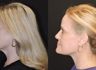 Facelift and Necklift – Zeiderman Patient 4