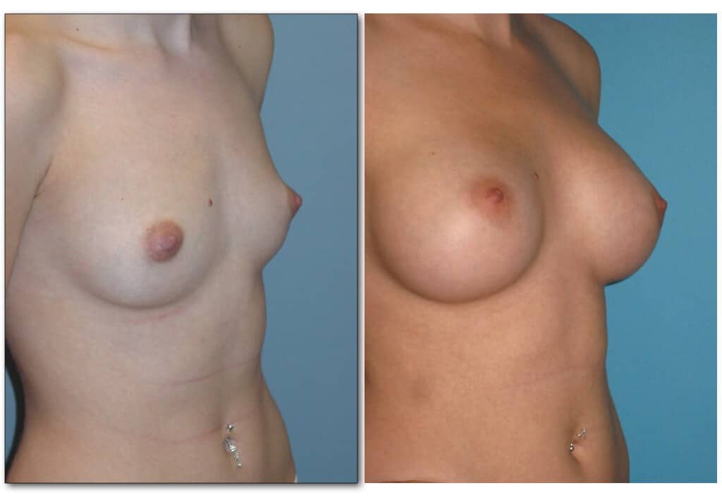 Breast-augmentation.003