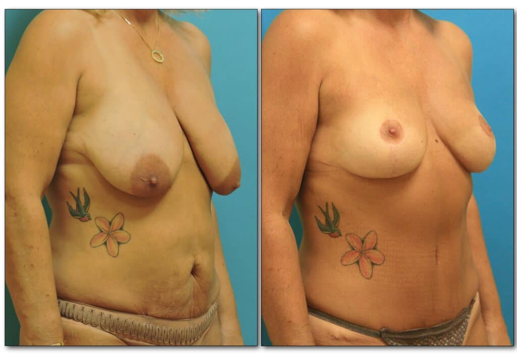 mommy-makeover-plastic-surgery-1